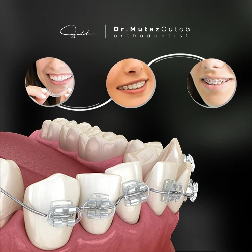 Why there are different types of orthodontic braces?